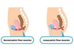 Is a Pelvic Floor Disorder Program in Demand?