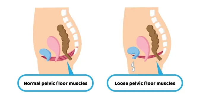 Is a Pelvic Floor Disorder Program in Demand?