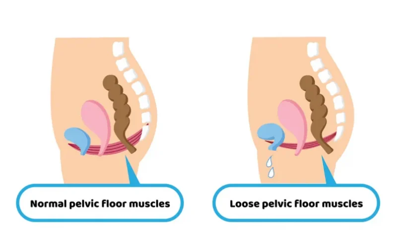 Is a Pelvic Floor Disorder Program in Demand?