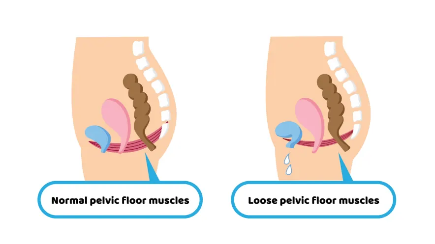 Is a Pelvic Floor Disorder Program in Demand?
